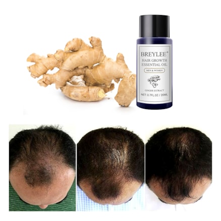 Essential Oil Ginger Extract Hair Growth 20ml