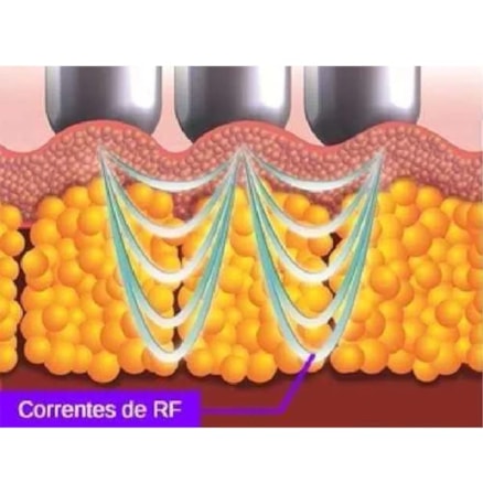 Mini Radiofrequência Portátil Facial Corporal